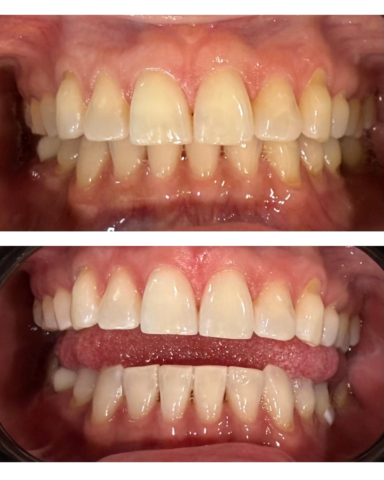 Registro comparativo de blanqueamiento dental, caso 1