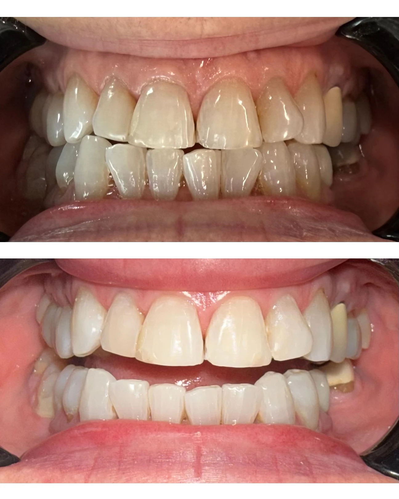 Registro comparativo de blanqueamiento dental, caso 2