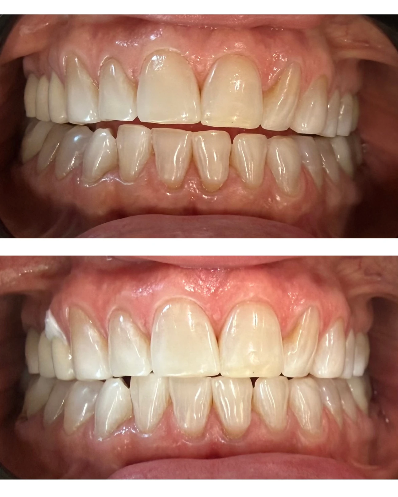 Registro comparativo de blanqueamiento dental, caso 3
