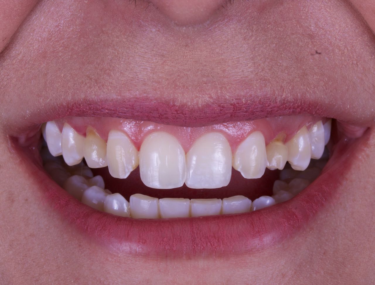 Detalle de los dientes