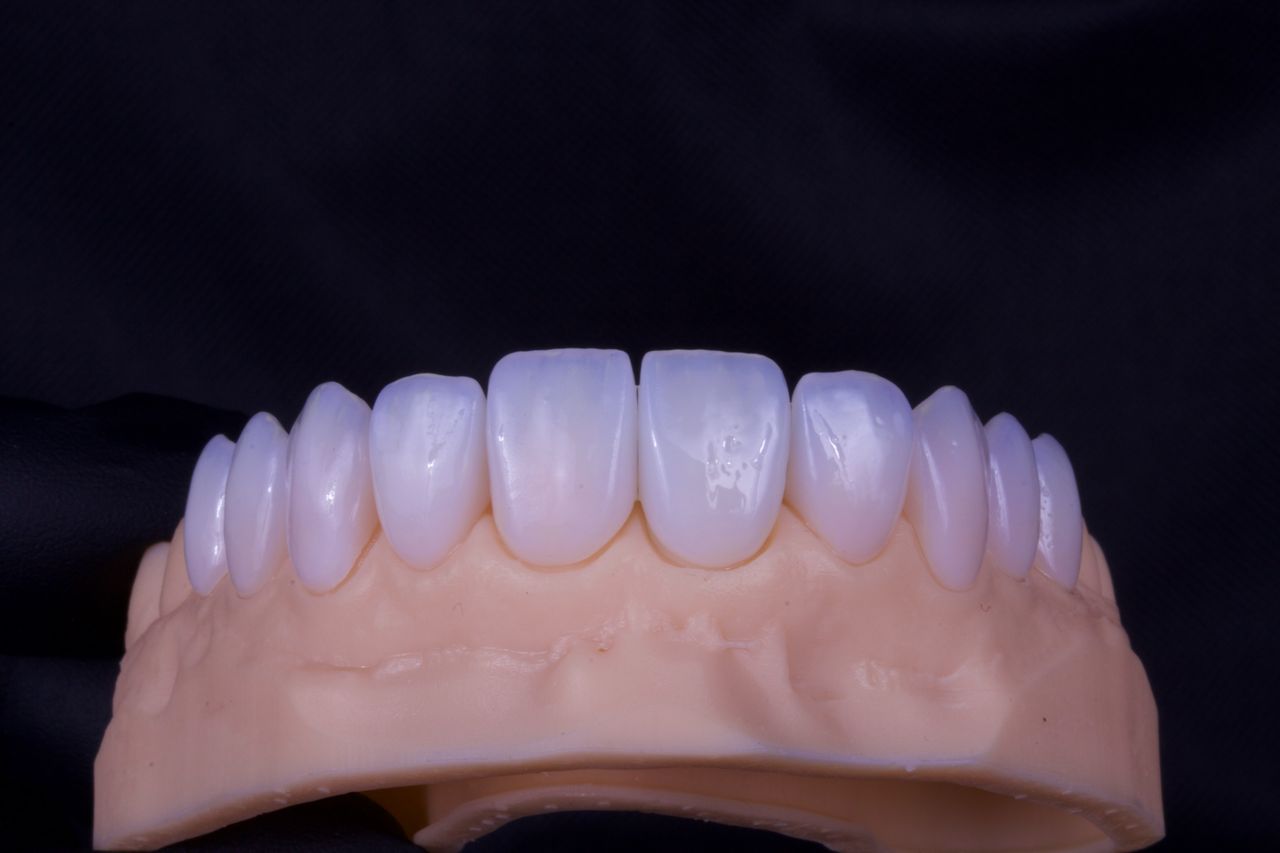 Detalle de carillas en un modelo dental