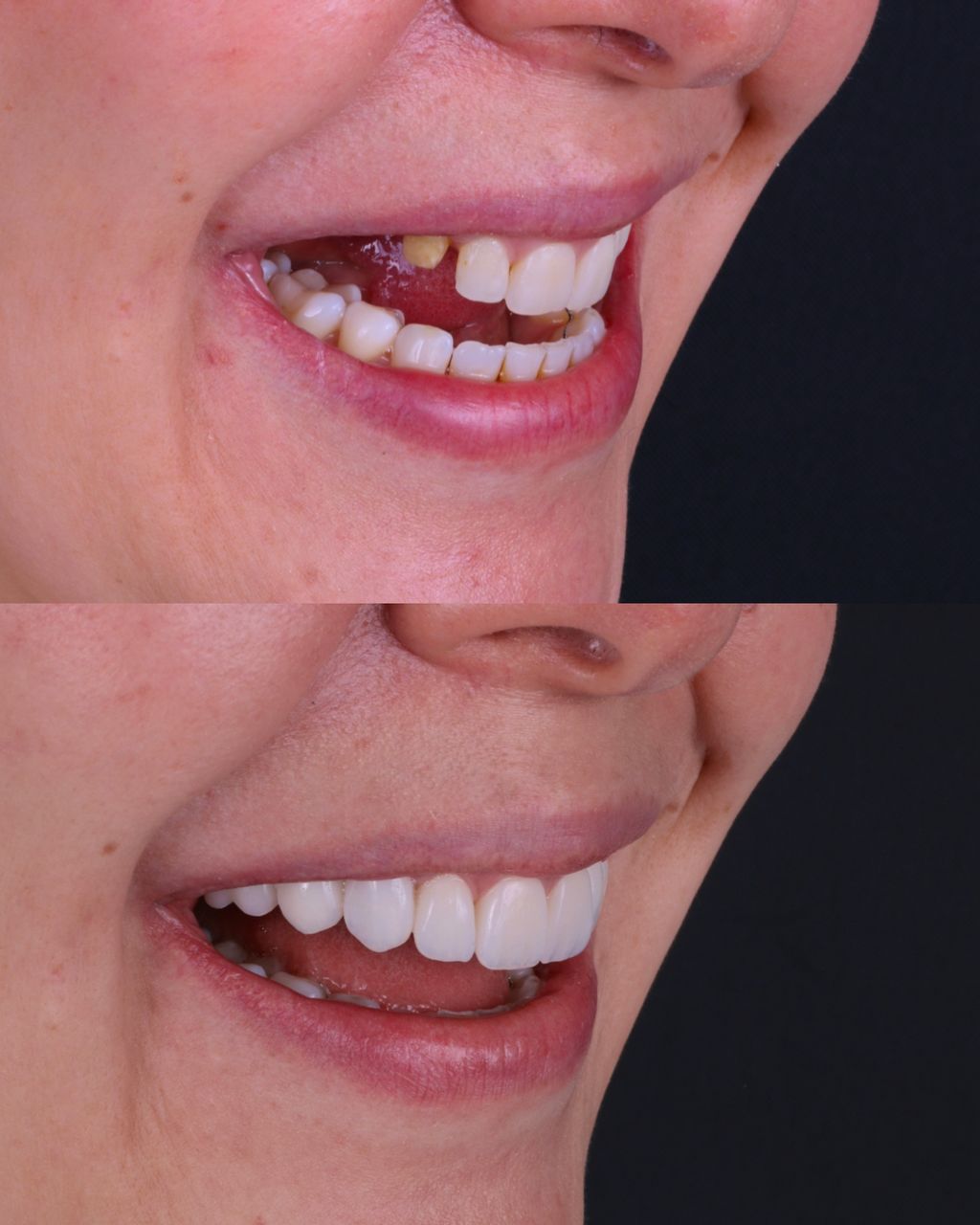 Registro fotográfico comparativo de la sonrisa