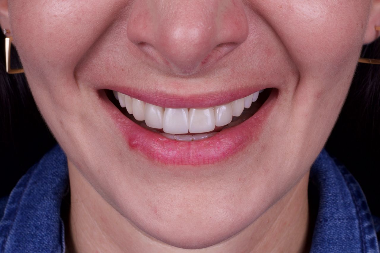 Detalle del tono de los dientes en una sonrisa