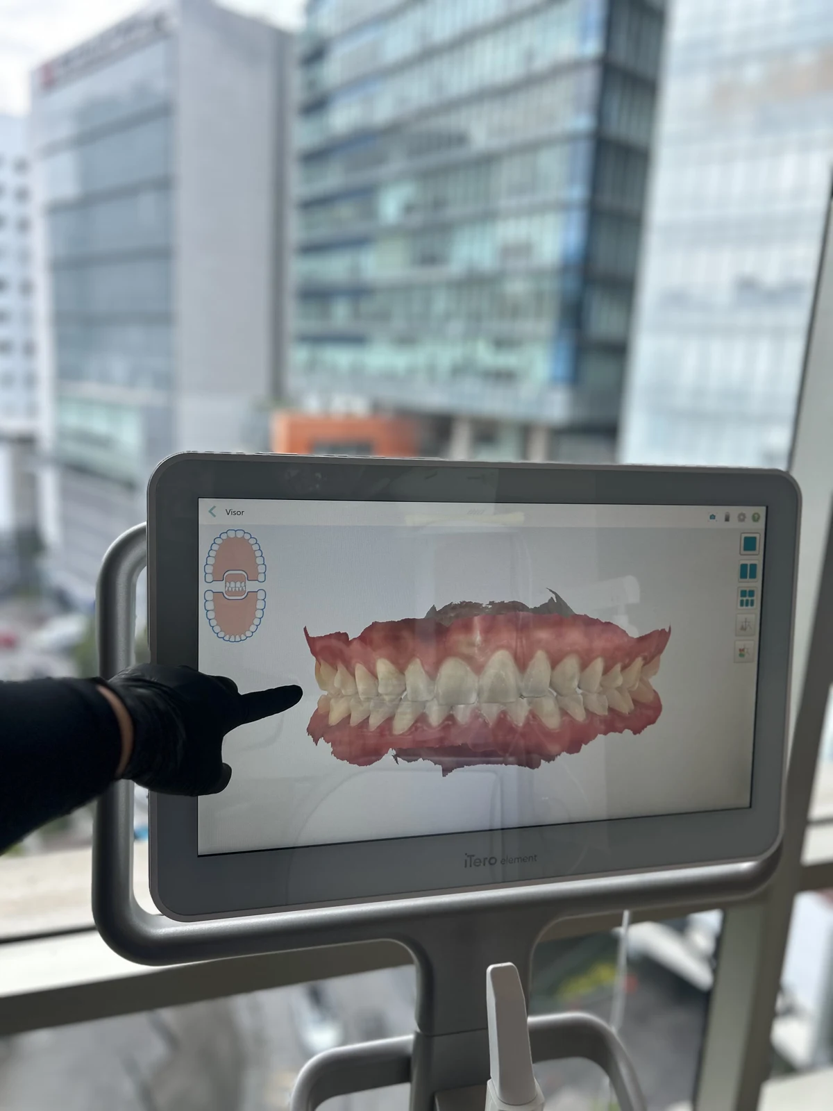 Registro digital de los dientes en la pantalla del escáner iTero